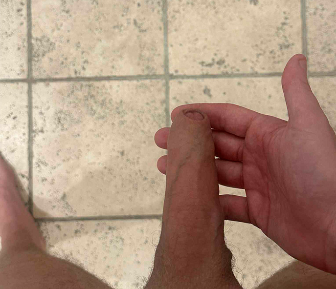 Before penis extender results