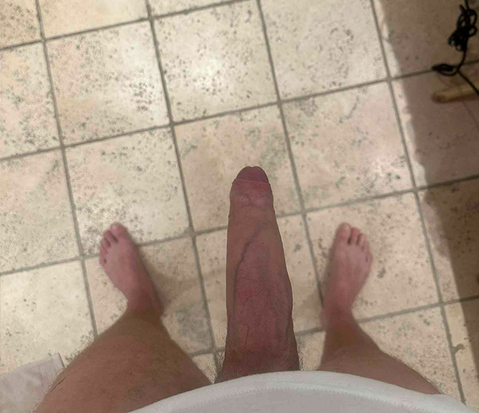 After penis extender results
